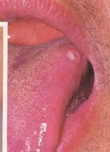 舌菌(舌乳头状瘤)